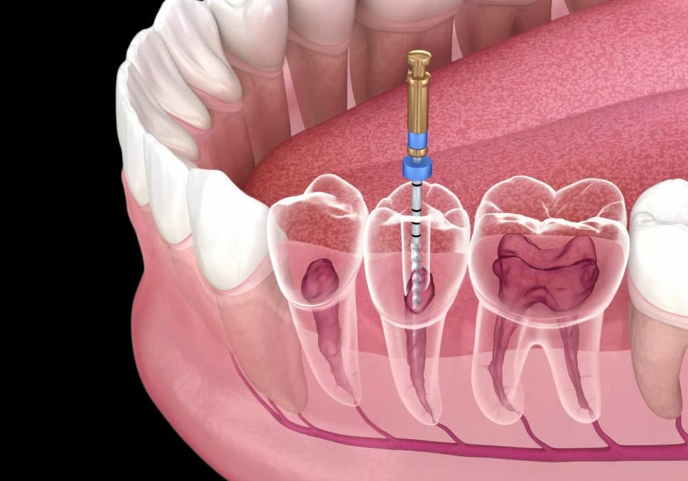 Root Canal Treatment