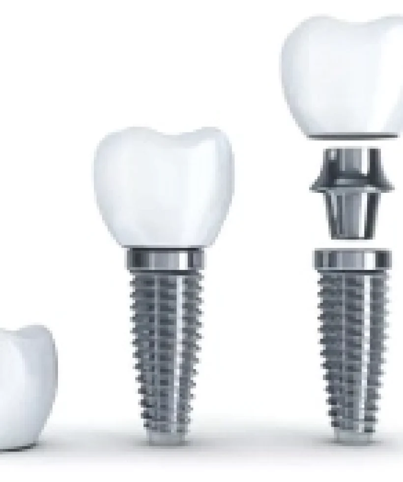 Dental-Implant Dental-Implant