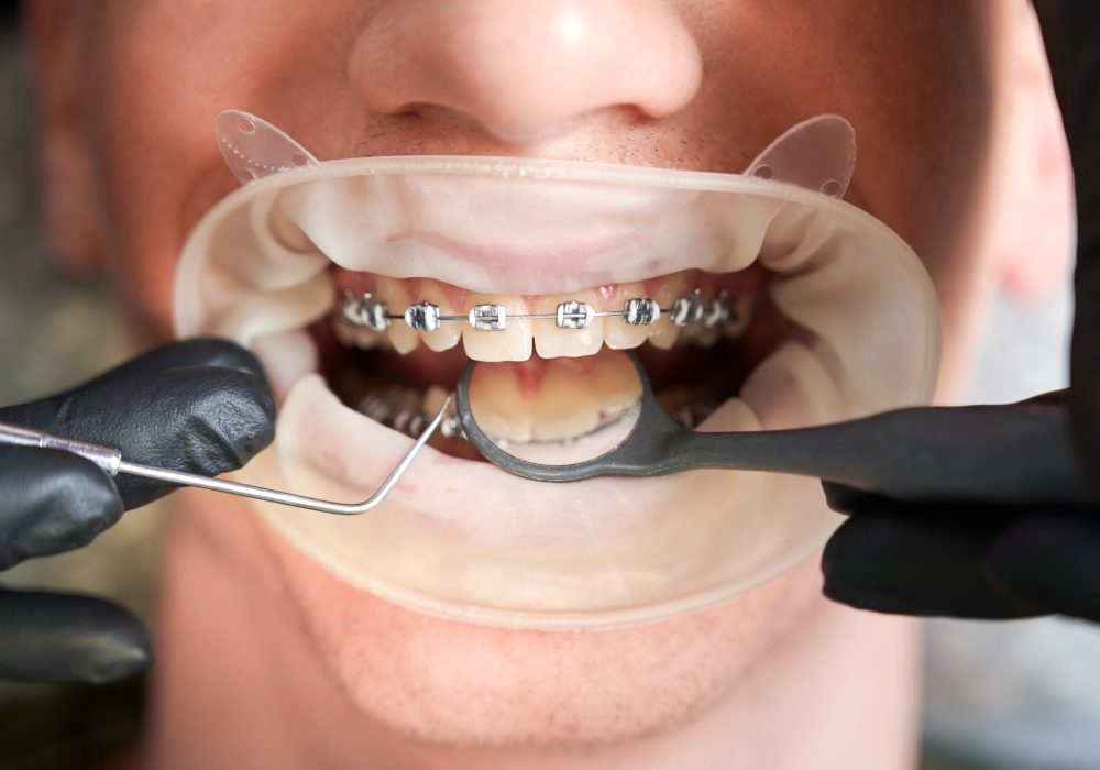 Macro photography of man's mouth with metal braces and cheek retractor. Dentist's hands in rubber gloves making teeth check up with dental tools. Cropped image. Top view. Oral hygiene concept