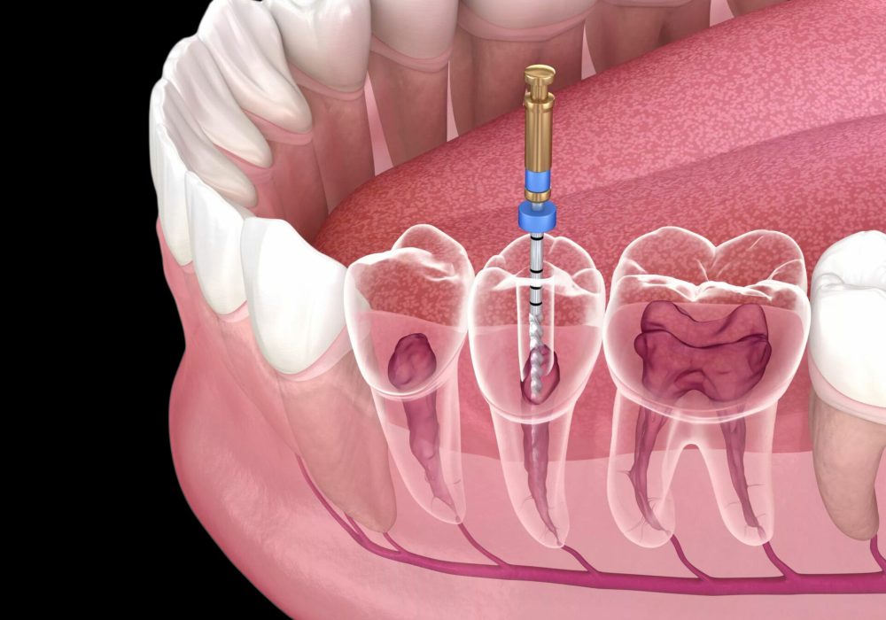 Root Canal